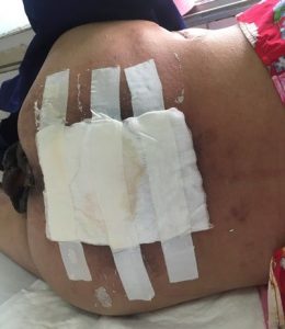 Thay Băng Loét Cho Người Già Bình Dương